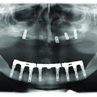 Patient 3 (panoramic radiograph performed in 2008): Eight hollow-screw ...