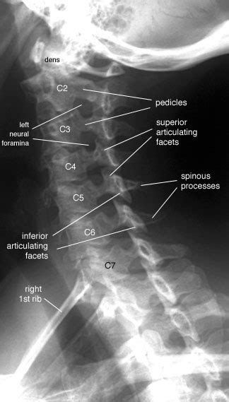 Radiographic Anatomy of the Skeleton: Cervical Spine -- Left Anterior ...