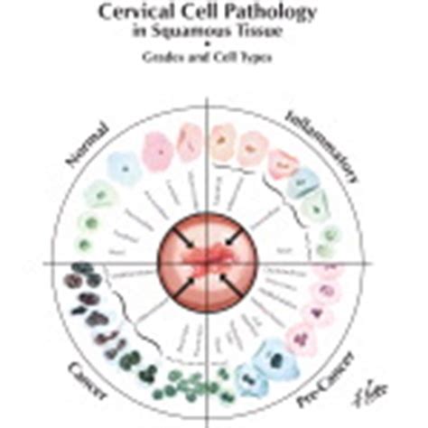 Abnormal Pap Smear: ASCUS or AGCUS Cervical Cell Pathology in Squamous ...