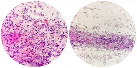 Paps smear. Microscopic examination of pap smear showing inflammatory ...