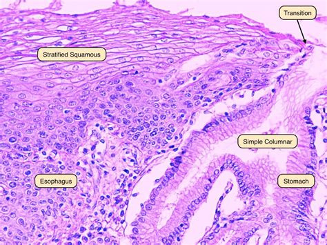 Barretts Esophagus Histology