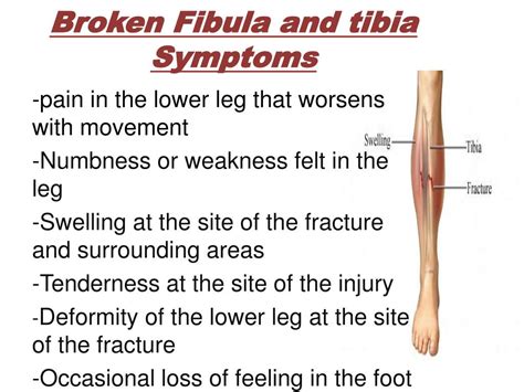 PPT - Fracture of fibula and tibia PowerPoint Presentation, free ...