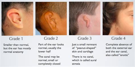 Microtia & Atresia | Ear Community