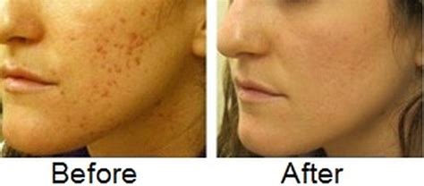 How to Fade Acne Scars Fast, Naturally, Diminish Acne Marks ...