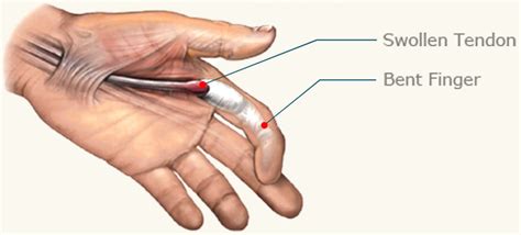 Trigger Finger - Causes, Symptoms, Splint, Exercises, Treatment