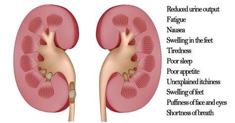 11 Kidney Cancer Symptoms (and How To Manage It Naturally)