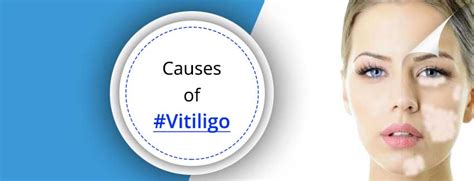 Causes of Vitiligo, Symptoms, Treatments, White Spots on Skin, Kayakalp ...