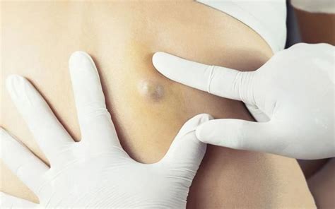 Cyst Removal Surgery: A Comprehensive Guide | Wotpost