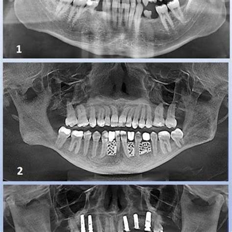 Cologne Classification of Alveolar Ridge Defects (CCARD) differentiates ...