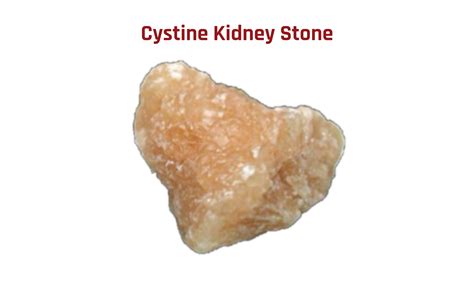 How to Prevent or Solve Kidney Problems: Types Of Kidney Stones