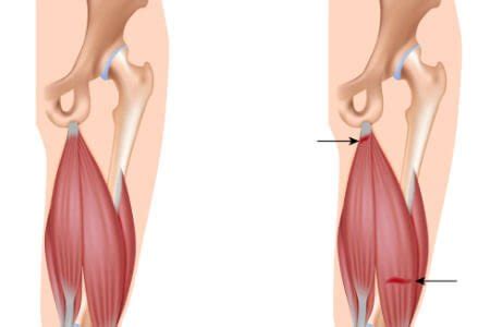 Hamstring Muscle Strain: Symptoms, Risk Factors and Complications