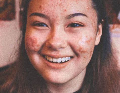 Pin on acne positivity ️