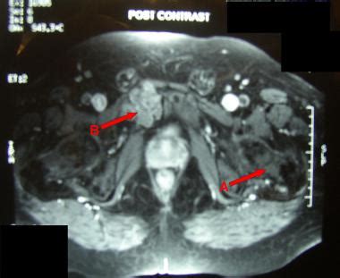 Chondroma: Overview, Pathophysiology, Epidemiology_About Surgery