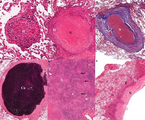 Tuberculosis Lungs Histology