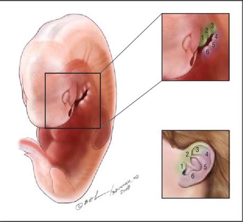 preauricular cyst excision