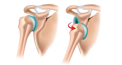 Dislocated Shoulder - Diagnosis, Causes, Treatment & Rehabilitation