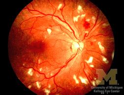 Cotton Wool Spots : Ophthalmoscopic Abnormalities : The Eyes Have It