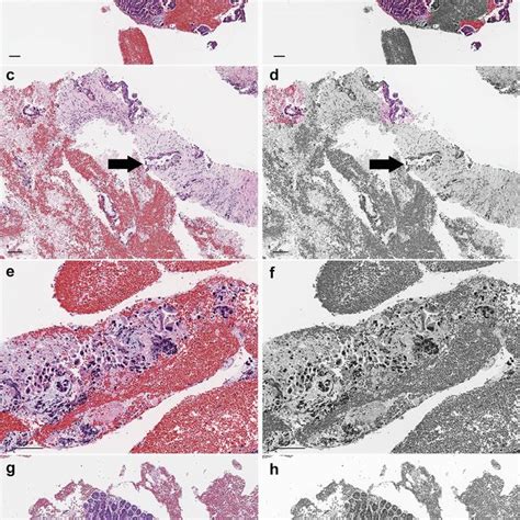 Histology Of Pancreatic Ductal Adenocarcinoma Pdac A Representative ...