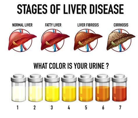 Stages of liver disease 1868462 Vector Art at Vecteezy