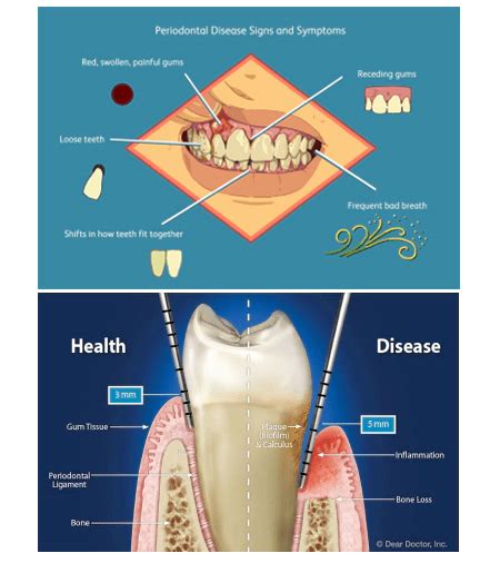 Flap Surgery & Gum Surgery in Hyderabad, India at FMS DENTAL