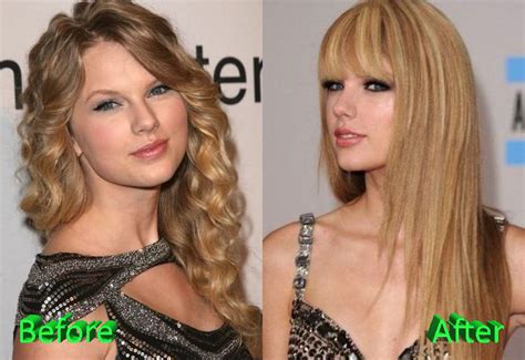 Taylor Swift Before and After Cosmetic Surgery