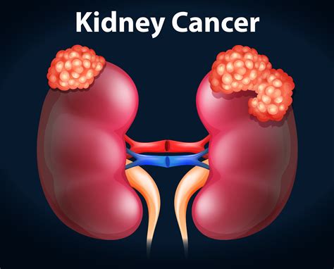 Kidney Cancer