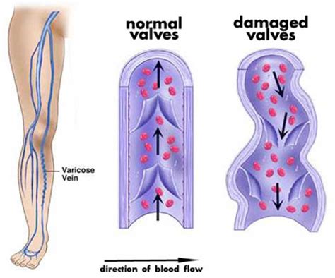 Causes of Varicose Veins