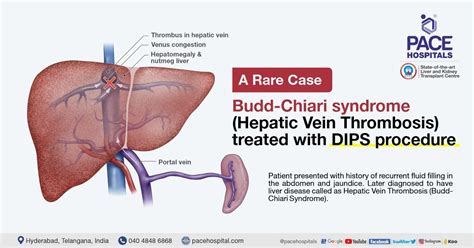 Budd-Chiari syndrome (Hepatic Vein Thrombosis) - DIPS procedure