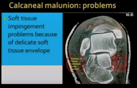 Calcaneal Malunion — OrthopaedicPrinciples.com