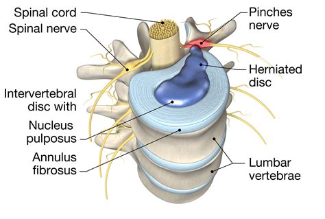 Types Of Disc Problems What Is The Difference Between A Bulging Porn