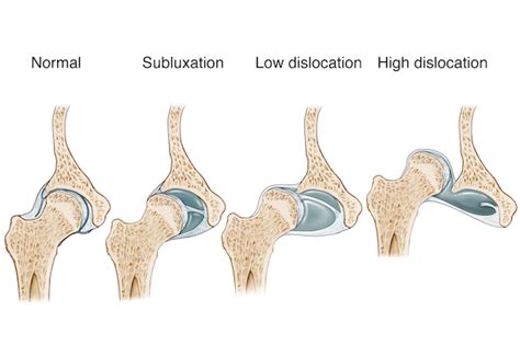 Hip Dysplasia