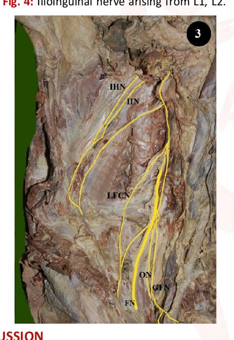 Ilioinguinal Nerve Entrapment