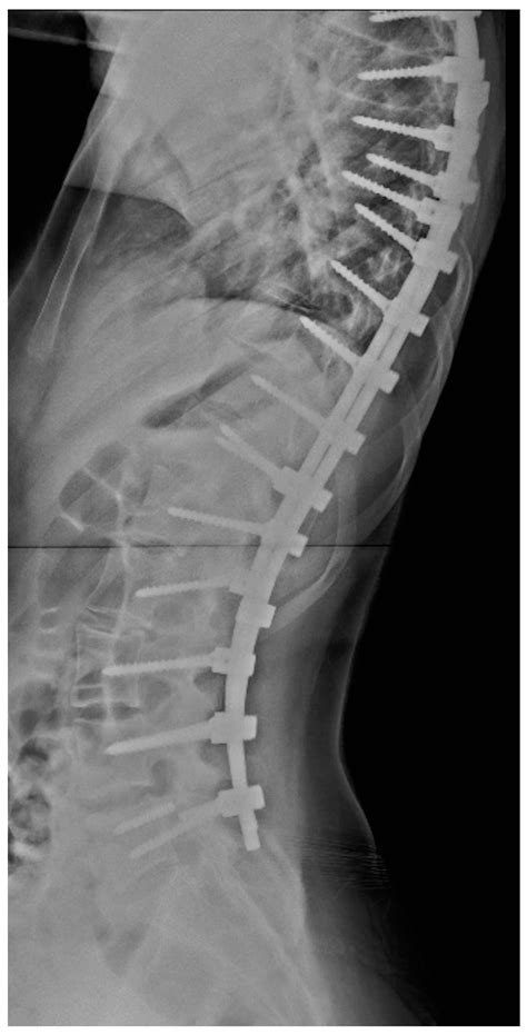 Applied Sciences Free Full Text Correlation Between Scoliosis