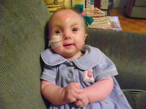 Pray For Lilly Trisomy 18 Awareness Day