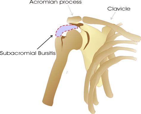 Subacromial Bursitis Causes Treatment Exercises Physiosunit