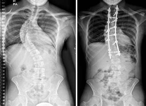 Adolescent Idiopathic Scoliosis The Bmj