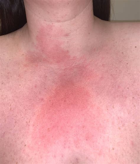 Rash On Neck And Chest