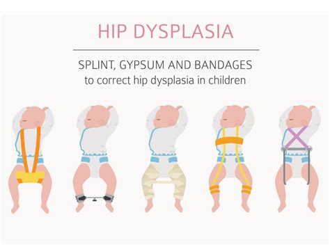 Can Early Diagnosis Help Children With Developmental Dysplasia Of Hip