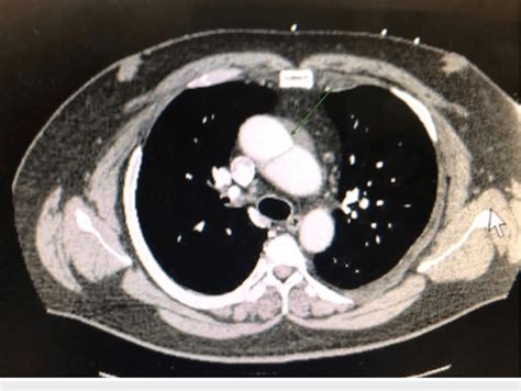 Ascending Aorta Dissection Ct Scan Of The Chest With Intravenous