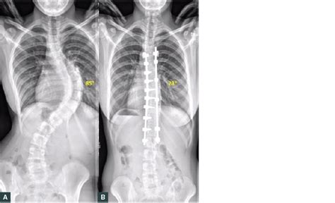 Racgp Paediatric Scoliosis