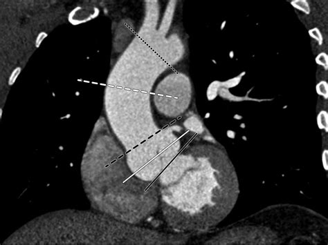 Ct And Mri Assessment Of The Aortic Root And Ascending Aorta Ajr