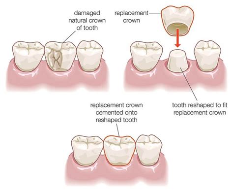 Dental Crown Treatment Dentist Crowns White Hills Bendigo