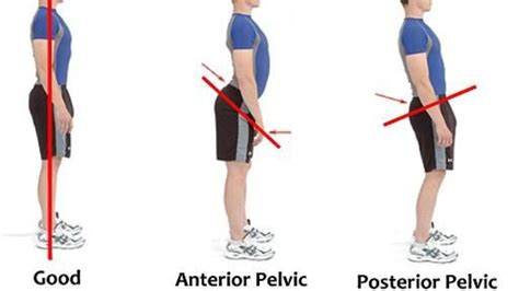 Importance Of Pelvic Alignment And Good Posture Dr Christine Schlenker