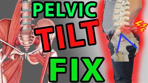 Best Fix Anterior Hip Tilt 1 Minute Exercises Pelvic Tilt Youtube