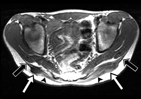 Mri Diagnosis Of Contracture Of The Gluteus Maximus Muscle Ajr