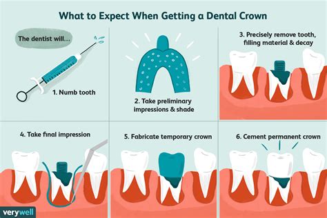 Everything You Need To Know About Dental Crowns