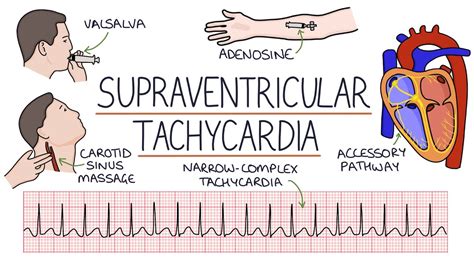 Supraventricular Tachycardia Vs Ventricular Tachycardia