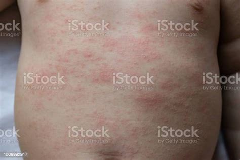 Red Itchy Rash On Babys Chest And Abdomen Stock Photo Download Image