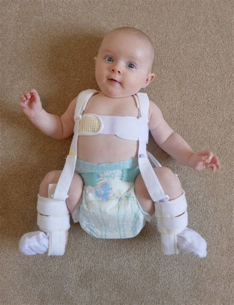 Have You Ever Met A Baby With Bi Lateral Hip Dysplasia Ergobaby