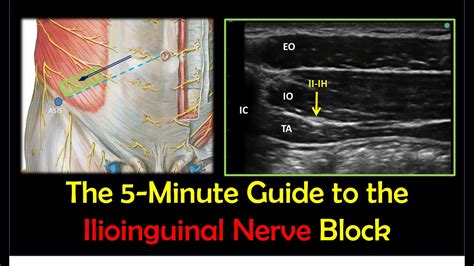 Ilioinguinal Nerve Block A How To Guide YouTube